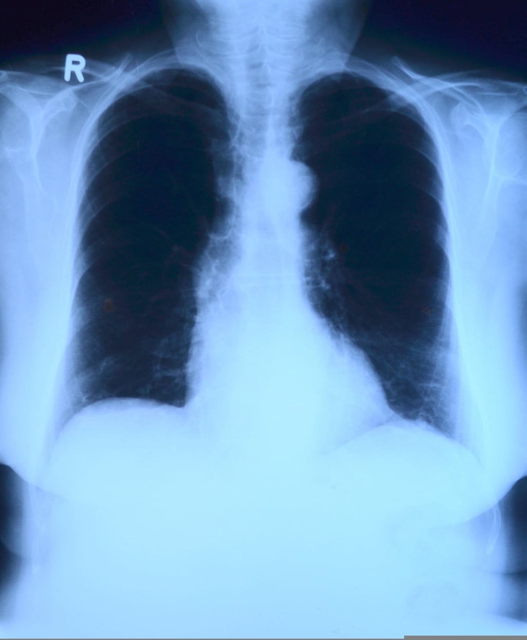 Lungs